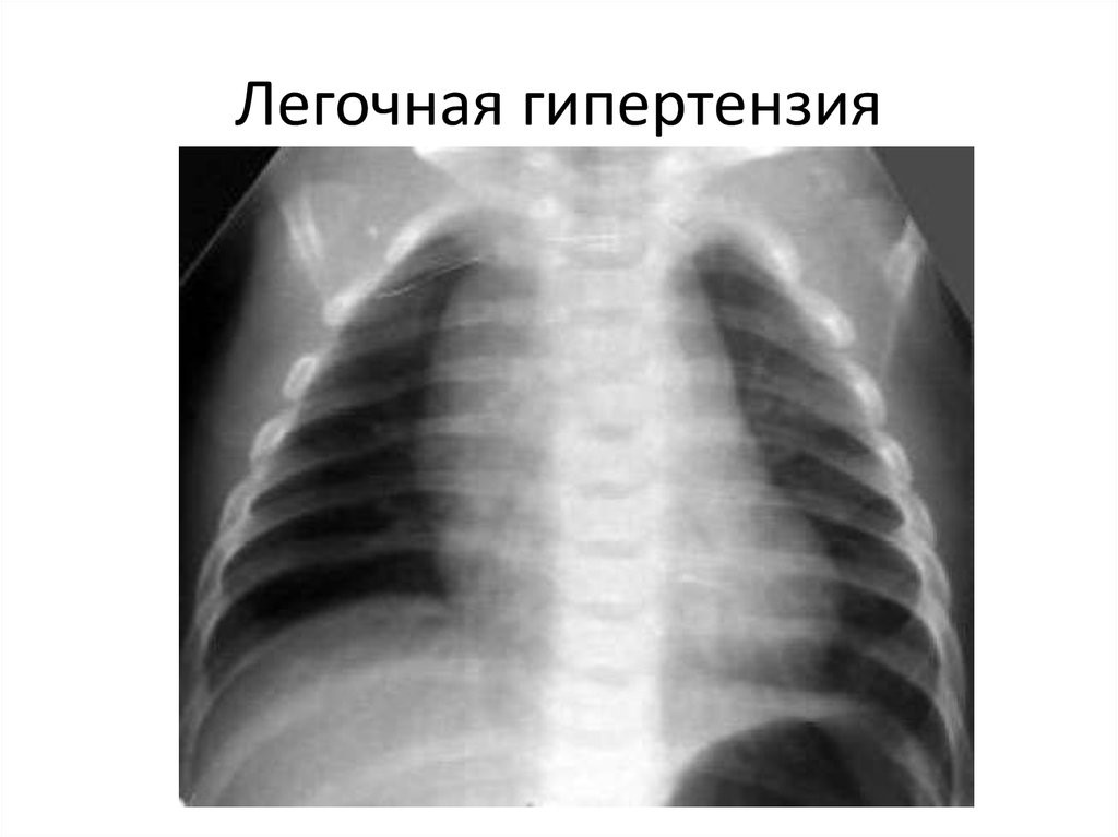 Легочная гипертензия рентген у детей. Рентгенограмма при легочной гипертензии. Легочная артериальная гипертензия рентген. Персистирующая легочная гипертензия.