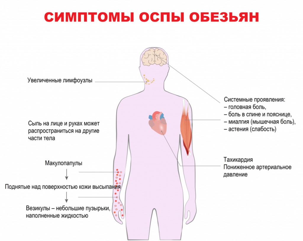 Оспа обезьян - 1-я городская детская поликлиника